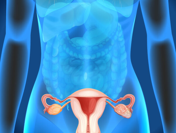 Was ist Endometriose (Schokoladenzyste)?