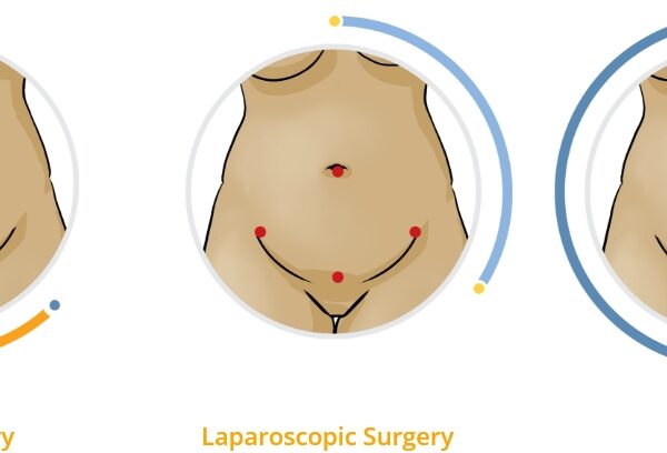 vNOTES (non-incision surgery)