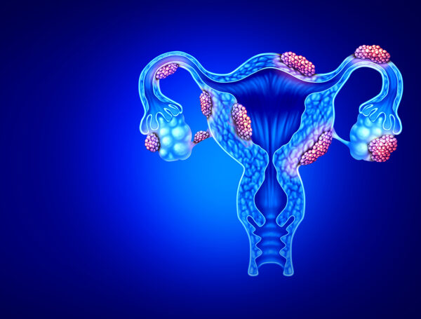 Can the severity of endometriosis be determined by blood tests?