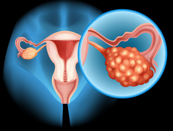 vNOTES surgery for Ovarian Cysts