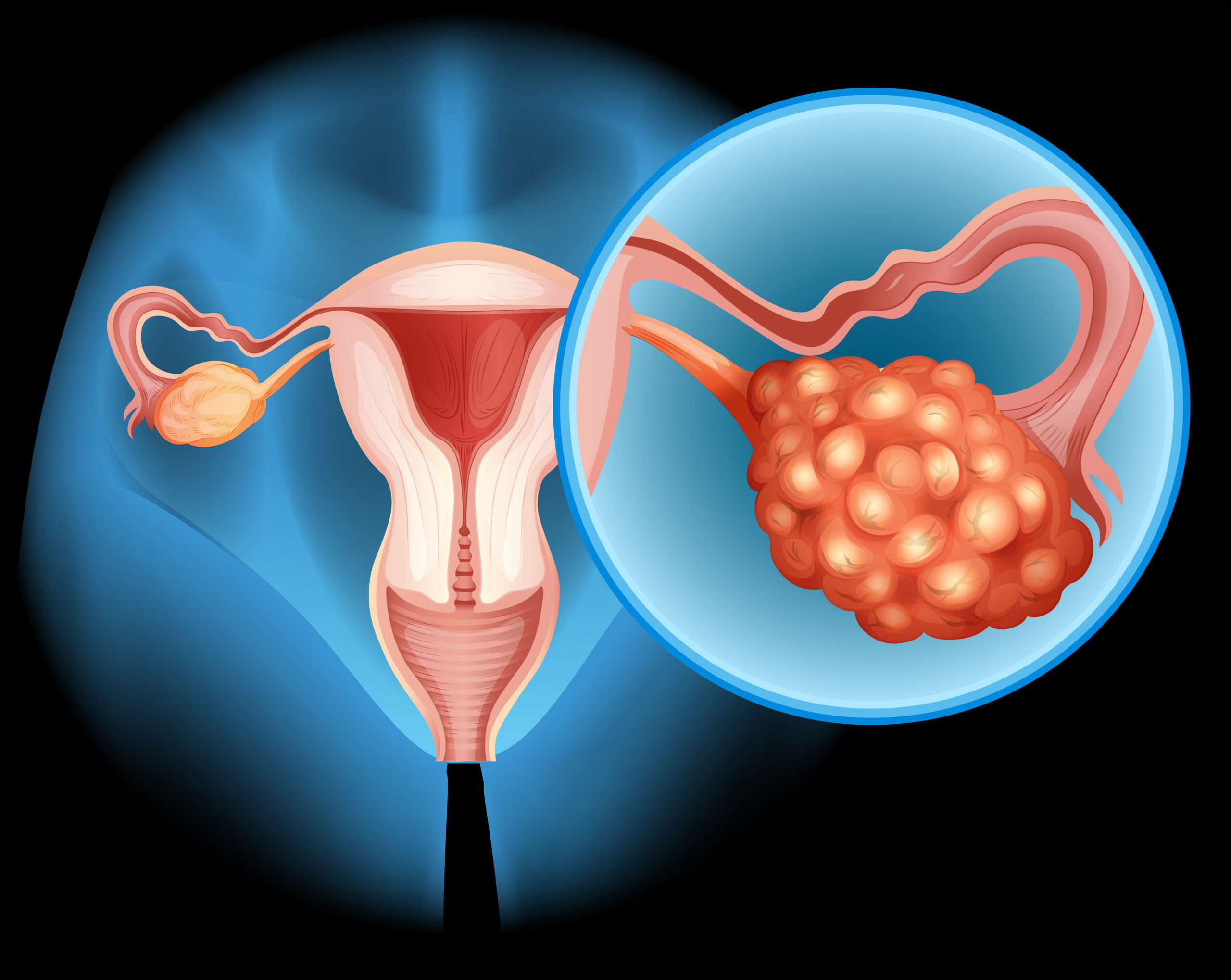 vNOTES surgery for Ovarian Cysts