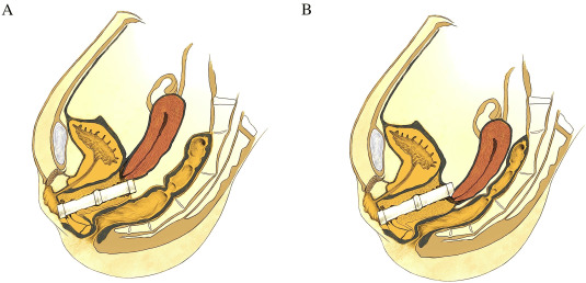 Can myoma and cyst surgeries be performed without an incision (vNOTES)?